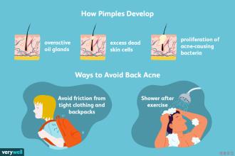 How pimples develop and Ways to avoid back acne