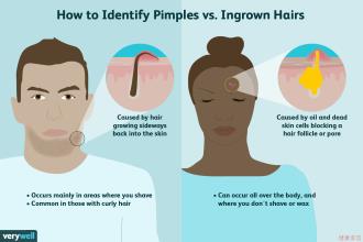 How to Identify Pimples vs. Ingrown Hairs
