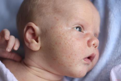 Baby with acne