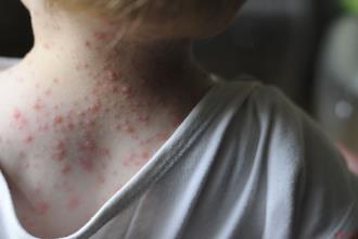 A child's neck covered with chicken pox