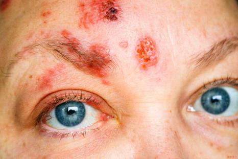 Shingles on face and around eye