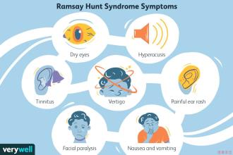 Ramsay Hunt Syndrome Symptoms
