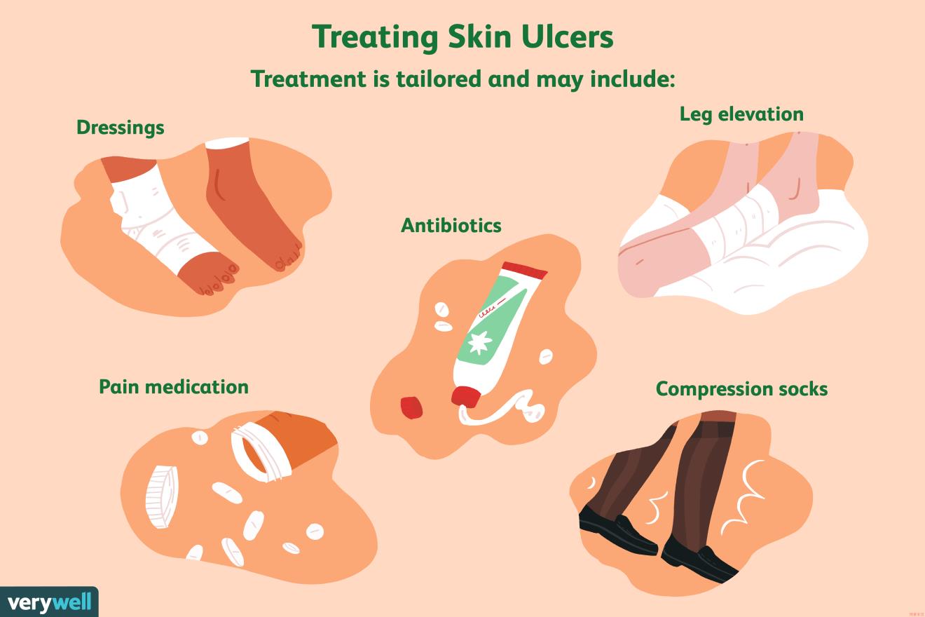 skil ulcer treatments
