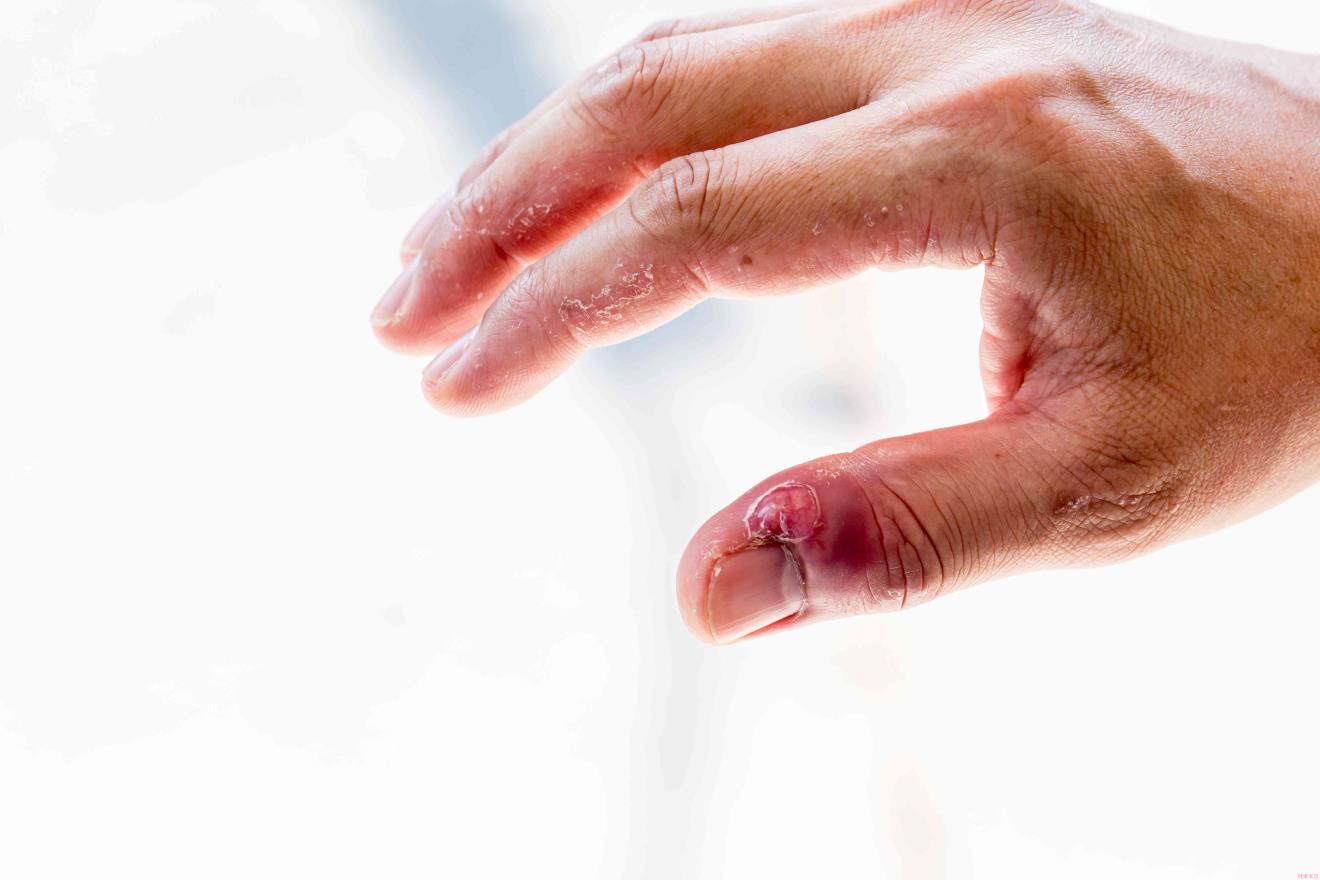 Paronychia: swollen finger with fingernail bed inflammation