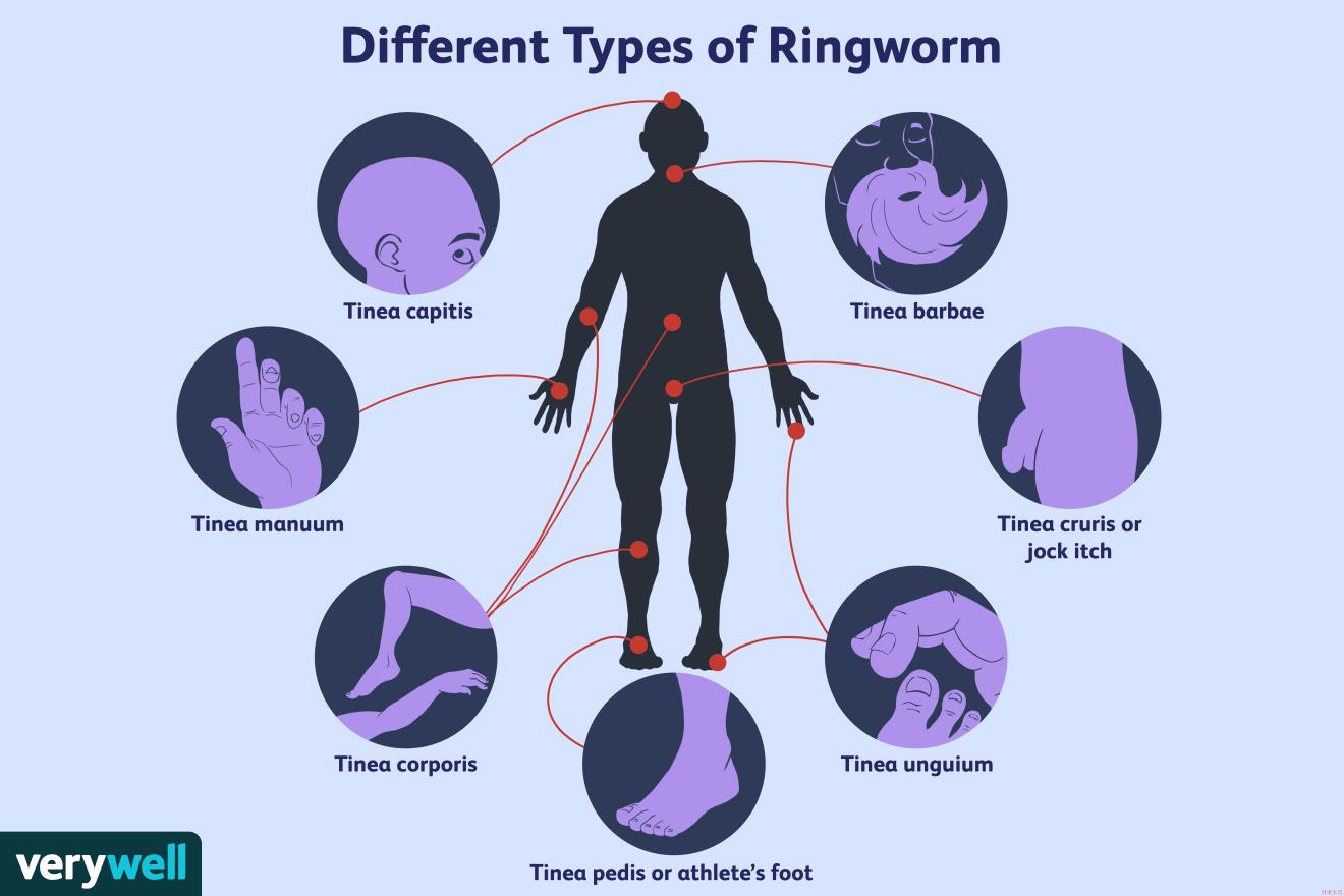 Different Types of Ringworm