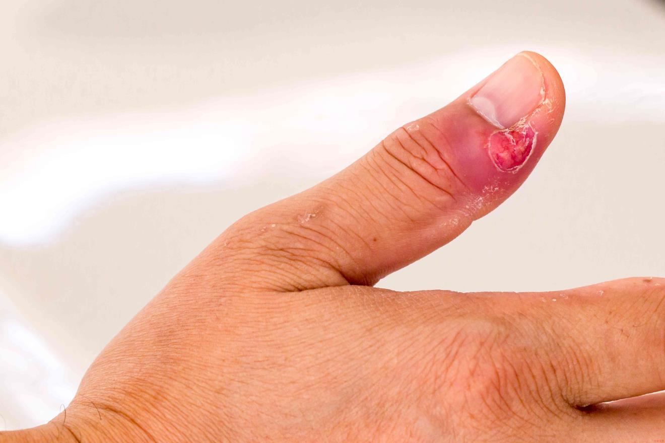 Paronychia, swollen finger with fingernail bed inflammation due to bacterial infection on a toddlers hand.