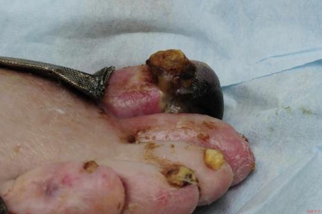 Gangrenous big toe of diabetic patient