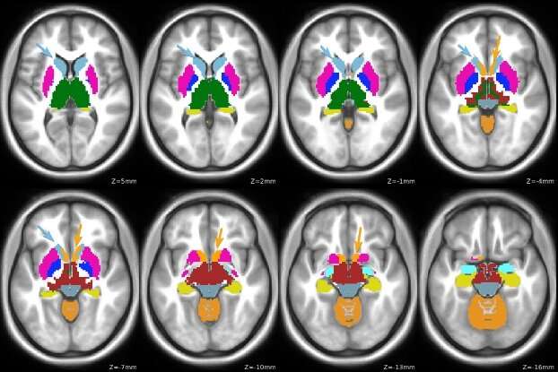 Study l<em></em>inks brain function changes to genetic risk in attention deficit/hyperactivity disorder diagnosis