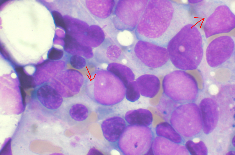 myeloid leukemia