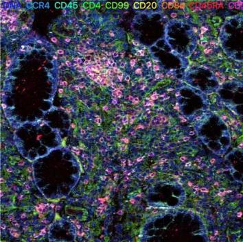 研究人员使用独特的成像技术绘制与炎症性肠病有关的细胞