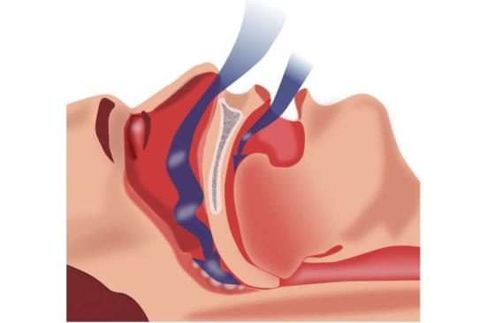 用CPAP治疗睡眠呼吸暂停可以降低心脏问题的风险