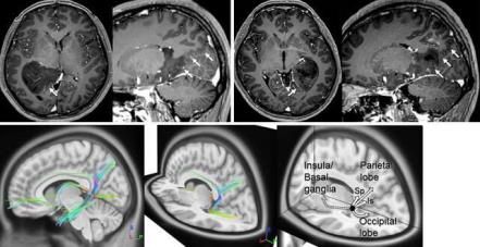 脑胶质瘤的侵袭可能受到顶枕裂、白质纤维的影响