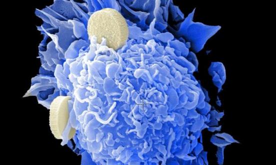 前列腺癌:“液体活检”可以对转移性癌症进行非侵入性诊断
