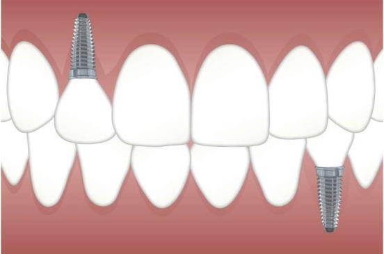 报告青霉素过敏的患者成功植牙的可能性较低