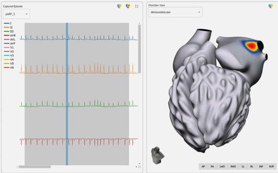 Arrhythmia Mapping Technology Demo<em></em>nstrates Positive Clinical Results