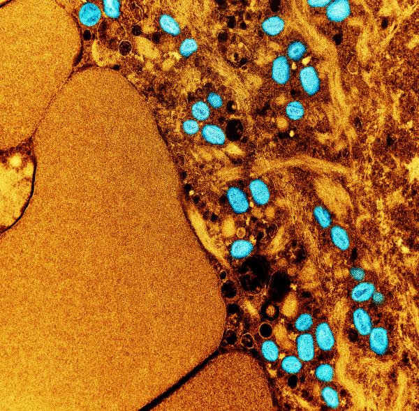 像对待性传播感染一样对待猴痘可能有助于控制疫情，但污名化是一种危险